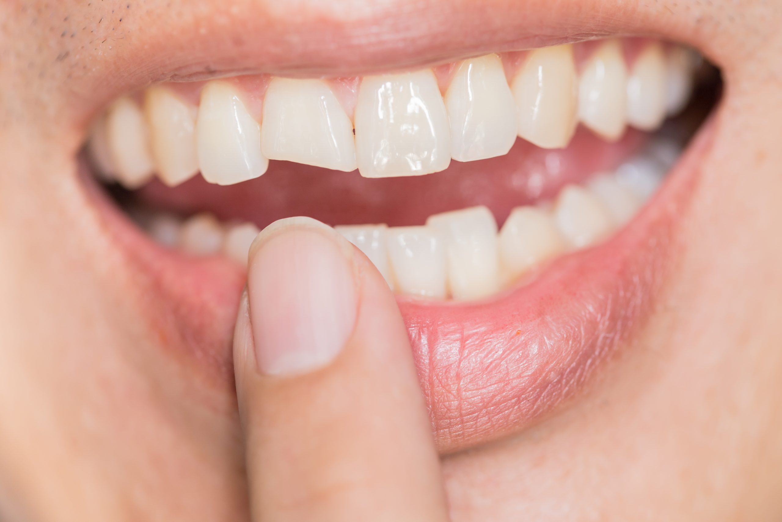 Signs, Causes, and Treatment for Cracked Teeth